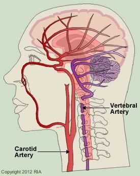 vertebral carotid arteries artery anatomy rnc vertibral chokes